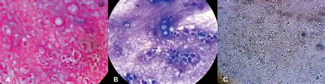 Figure 1 From Acute Disseminated Paracoccidioidomycosis In A 3 Year Old