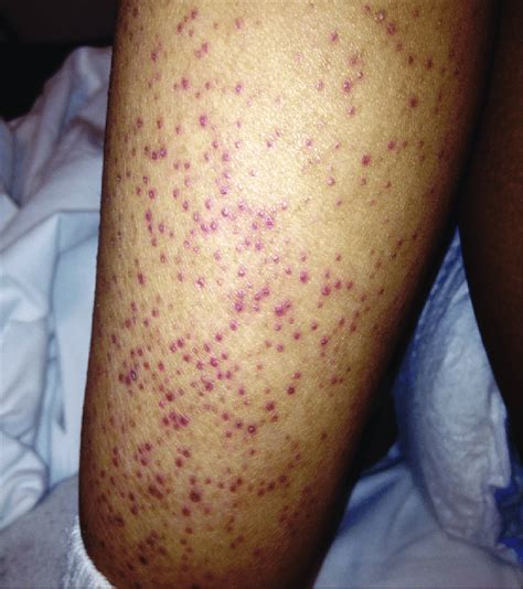 A Non Pruritic Non Painful Petechial Rash On Lower Leg Of Year Old Download Scientific