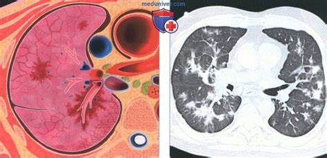 Лучевые признаки саркомы Капоши в легких Картинка - Лучевые признаки саркомы Капоши в легких