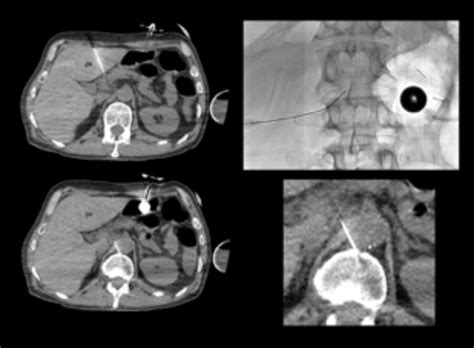 Non Traditional Thoracic Duct Embolization Using An Angio Ct System