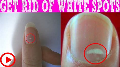 How To Get Rid Of White Spots On Nails Within 3 Days White Spots On