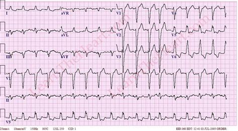 Left Bundle Branch Block Ecg