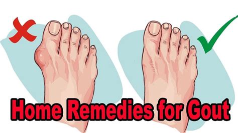 Home Remedies For Gout 10 Home Remedies For Gout That Help Ease The