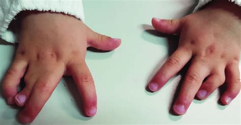 Congenital Malformation Of Both Hands Right Hand With Complete