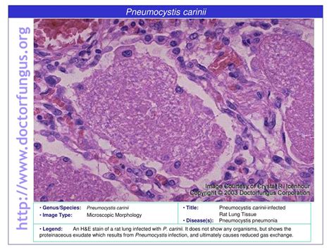 Ppt Pneumocystis Carinii Powerpoint Presentation Free Download Id