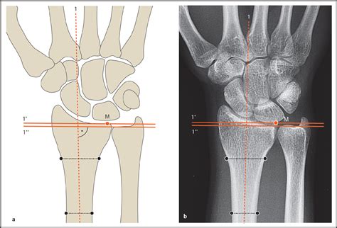 Wrist And Hand1 Radiology Key
