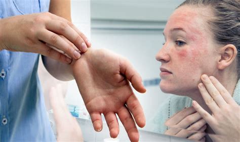 Eczema Treatment Three Nhs Recommendedways To Soothe Symptoms And Ease The Rash Uk