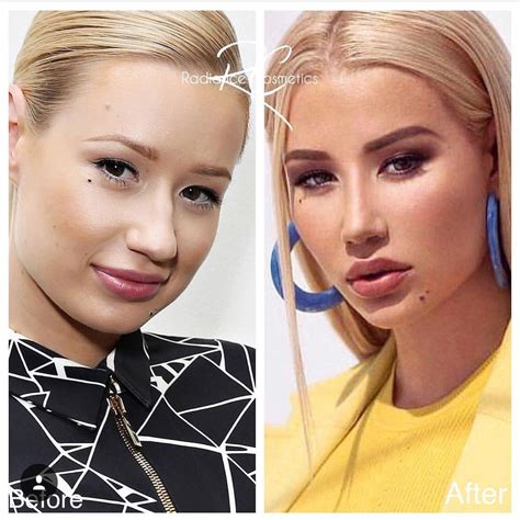 pin by pedro rodriguez on celebrities before and after cheek fillers plastic surgery nose