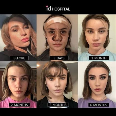 6 Months After Facial Feminization Surgery In Id Hospital Korea 🌸 Facialfeminization Ffs