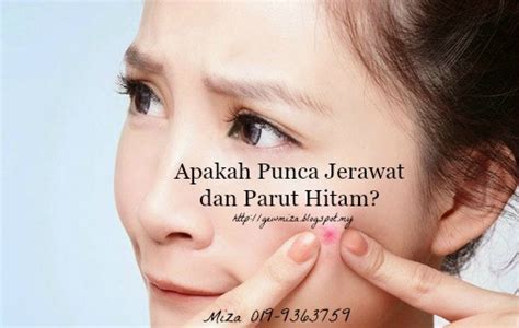 Maybe you would like to learn more about one of these? 4 Cara Hilangkan Parut Jerawat Dengan Cepat Tanpa ...
