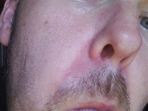 Eczema Around Nose Pictures Photos