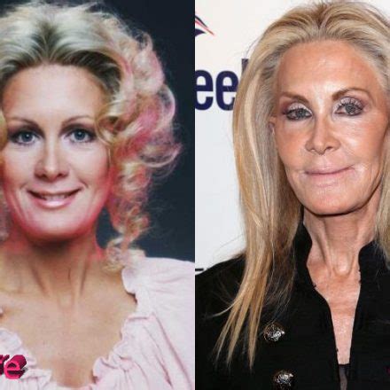 Joan Van Ark Plastic Surgery When Everything Goes Wrong