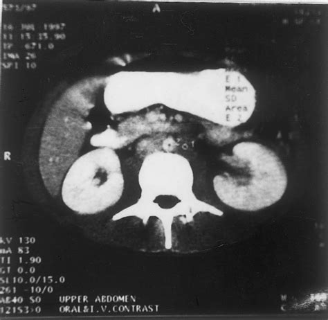 Ct Scan Of Abdomen Showing Marked Retroperitoneal Download Scientific