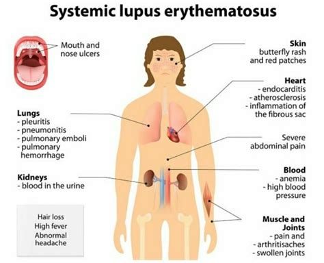 What Is Lupus Erythematosus Disease Siawht