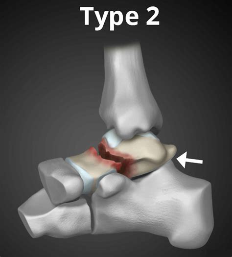 Talus Fracture Causes Types Symptoms Complications Diagnosis