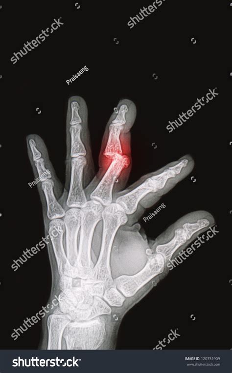 Wrist And Hand X Rays Image Show Fracture And Dislocation Bone Stock