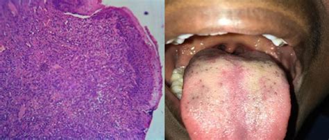 Traumatic Fibroma Of The Tongue A Treatment Modality Study