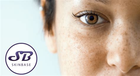 Treating Pigmentation With Skinbase Therapies Skinbase Facial