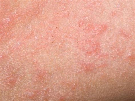 Generalized Pustular Psoriasis The Very Rare Disease That Afflicts 150