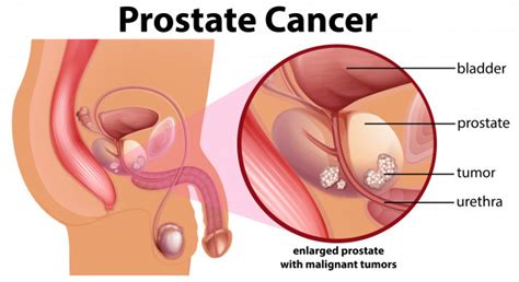 Cancerul De Prostata O Sentin A Capitala Dr Pecec Simona