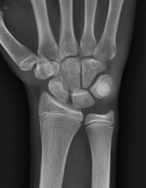 Tenosynovitis Wrist Radiology Case