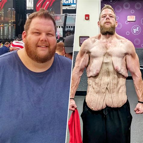 He Started Walking And Lost 360 Pounds But Loose Skin Makes Him Feel