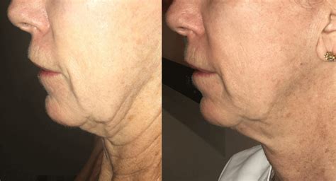 Morpheus8 Microneedling Before And After Men Medispa Physimed