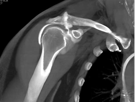 Shoulder Arthrogram With Rotator Cuff Tear Musculoskeletal Case