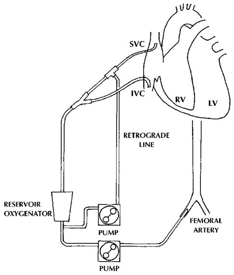 Extracorporeal Circuit Diagram