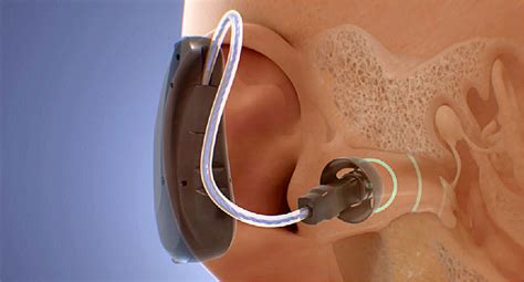 We did not find results for: Video on How Do Hearing Aids Work?
