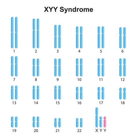 47xyy Syndrome Pictures