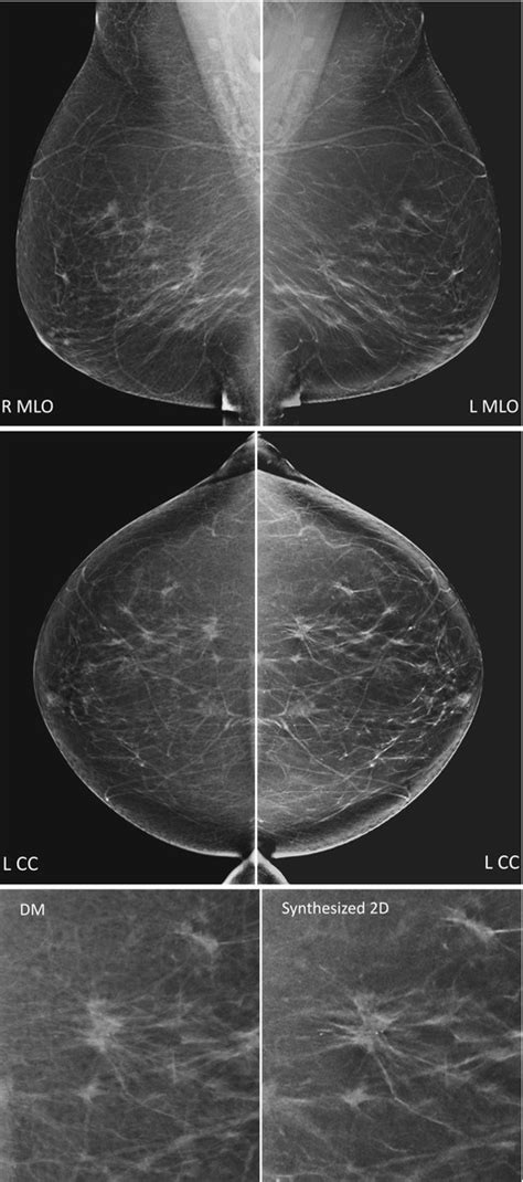 Digital Mammography And Digital Breast Tomosynthesis Oncohema Key