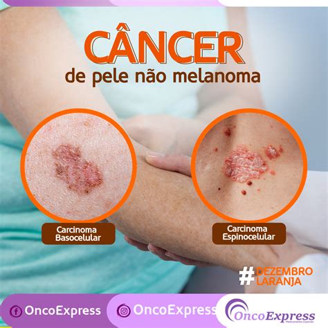 Câncer não Melanoma OncoExpress