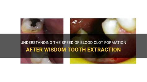 Understanding The Speed Of Blood Clot Formation After Wisdom Tooth