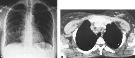 140 - Inflammatory Diseases of the Esophagus | General Thoracic Surgery