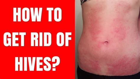 Pin On Urticaria Treatment