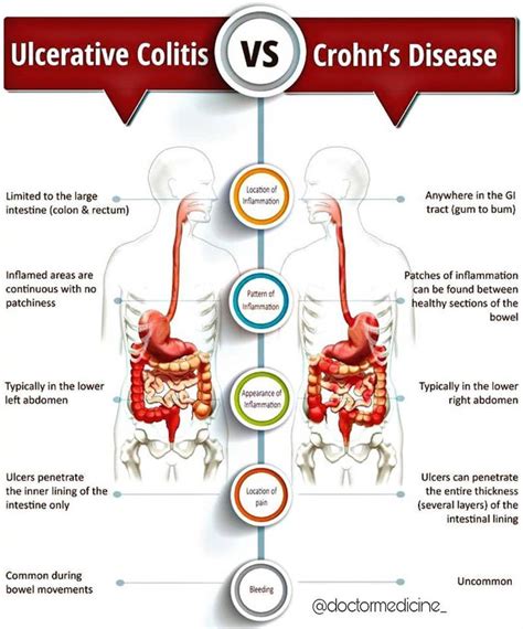 Crohn S Disease Vs Ulcerative Colitis