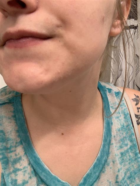Help With These Bumps All Over Chin And Jaw Routine Help R