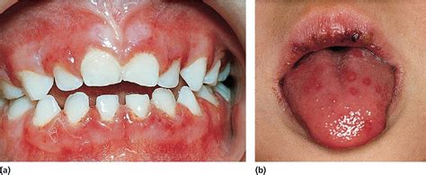 In this article, we'll explore the common causes and remedies of this condition and also answer questions such as: Oral Soft Tissue Lesions and Minor Oral Surgery - Pediatric Dentistry - a Clinical Approach, 3ed.