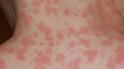 Amoxicillin Rash Pictures Medical Pictures And Images 2022 Updated