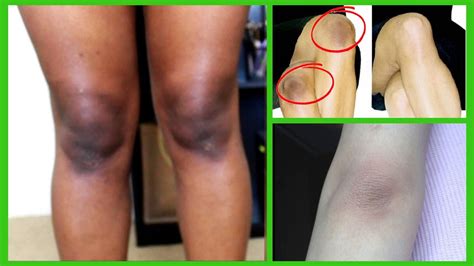 How To Lighten Dark Knees And Elbows Quick And Naturally At Home Youtube