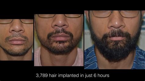 Beard Restoration By Dhi Technique Amazing Beard Hair Transplant