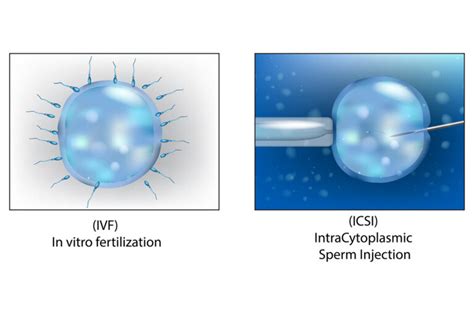 Ivf And Icsi Advanced Fertilization Procedures That Bring Potential Hopes To Couples Royal