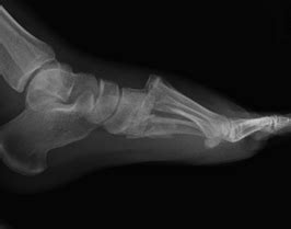 In the middle region of your foot (midfoot), a cluster of small bones form an arch. Lisfranc Injury - JUNIORBONES