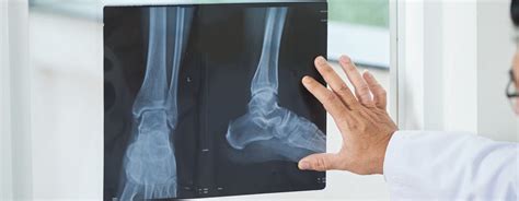 Ankle Fracture Recovery Orange County Foot And Ankle Doctor