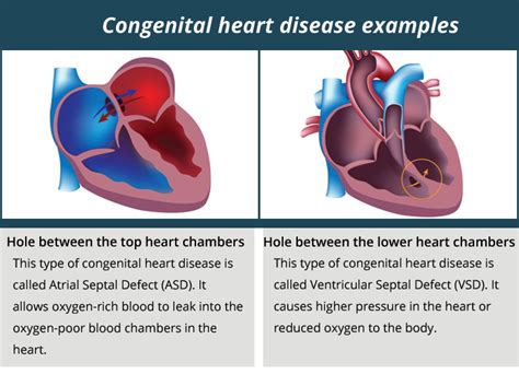 Most Common Cyanotic Congenital Heart Disease Captions Pages