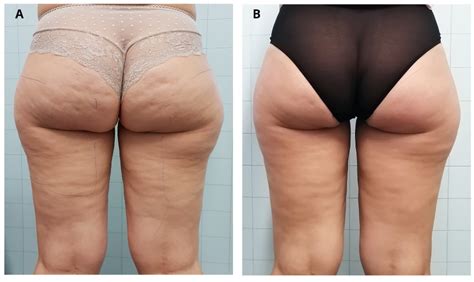 jcm free full text microwave therapy for cellulite an effective non invasive treatment