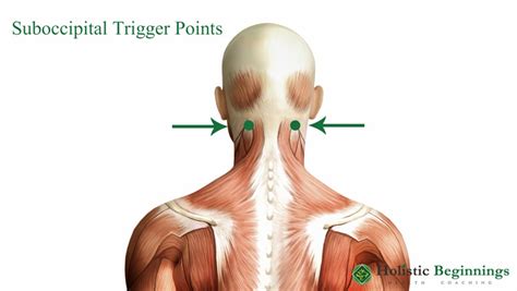 Naturally Cure Headaches With These 4 Trigger Points