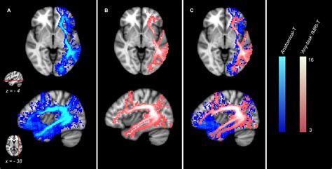 frontiers fmri targeted high angular resolution diffusion mr tractography to identify
