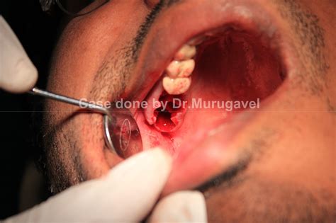 Dr Murugavel S Dental Implant Course Upper Bilateral Decayed Molars Extraction Immediate